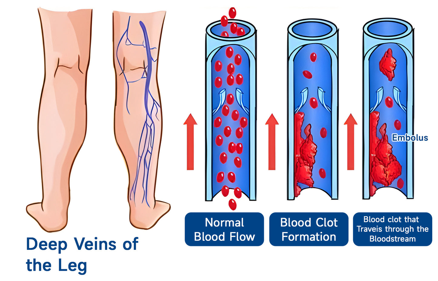 🧖‍♀️Targets Varicose Veins, Spider Veins, Leg Swelling, and Leg Fatigue. Ourlyard® Varicose Vein Stick Delivers Incredible Relief. Don't Miss 30% Off Today!