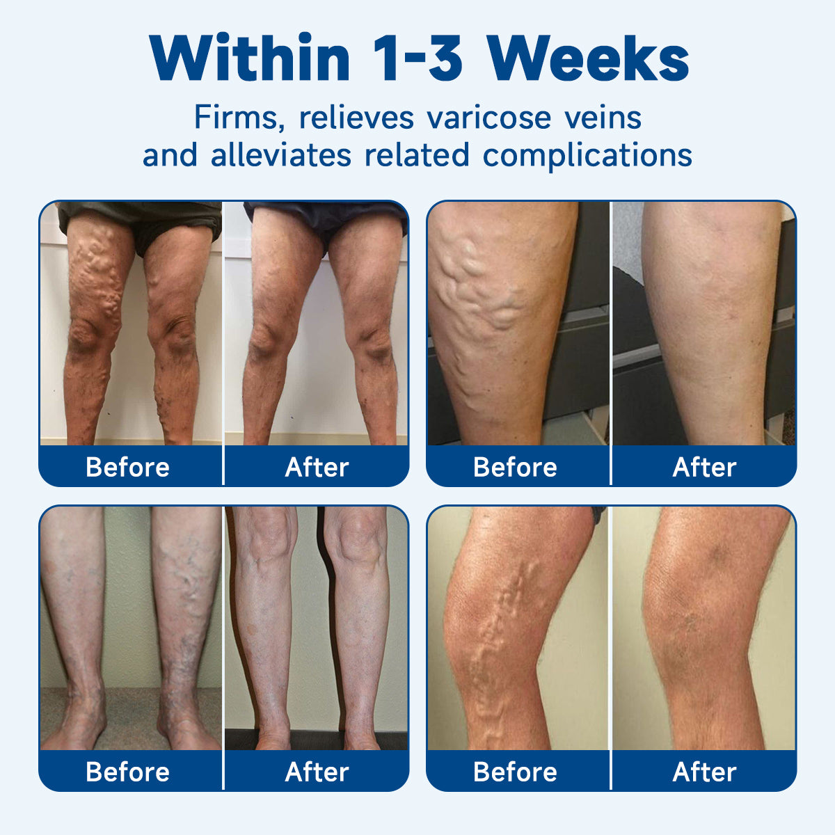 🧖‍♀️Targets Varicose Veins, Spider Veins, Leg Swelling, and Leg Fatigue. Ourlyard® Varicose Vein Stick Delivers Incredible Relief. Don't Miss 30% Off Today!