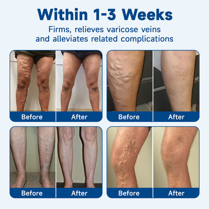 🧖‍♀️Targets Varicose Veins, Spider Veins, Leg Swelling, and Leg Fatigue. Ourlyard® Varicose Vein Stick Delivers Incredible Relief. Don't Miss 30% Off Today!