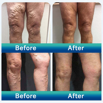 🧖‍♀️Targets Varicose Veins, Spider Veins, Leg Swelling, and Leg Fatigue. Ourlyard® Varicose Vein Stick Delivers Incredible Relief. Don't Miss 30% Off Today!